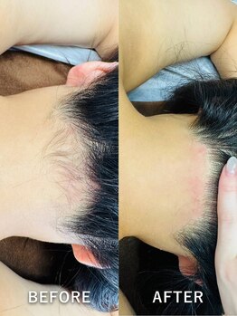 ルーク(Luke)/うなじ脱毛