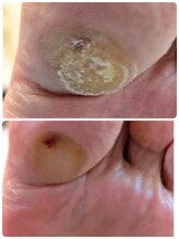 フットケアサロン ラビフット(Rabbi foot)/浮指に関連したタコ