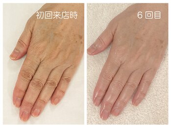 キレイテ 福岡天神店/シミとハリのなさ