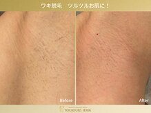トゥジュール イエリック(Toujours ierik)/ワキ脱毛ツルツルお肌へ