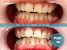 セルフホワイトニング専門店 シマエナ上新庄駅前店/1回で自然な白さ