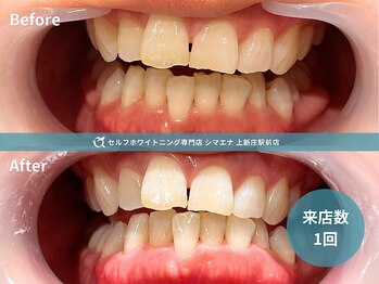 セルフホワイトニング専門店 シマエナ上新庄駅前店/1回で自然な白さ