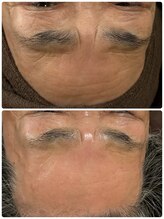 ナナラ(NANALA)/シワ、たるみ改善