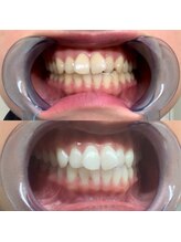 ライトケアサロン 表参道店(Light Care Salon)/セルフホワイトニング