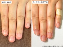 カピリナ(Ka Pilina)/自爪育成・深爪・川崎