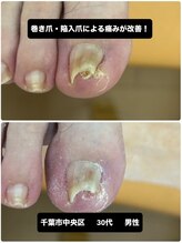 巻き爪じゅん 千葉駅前店/陥入爪の痛み専門施術でサポート