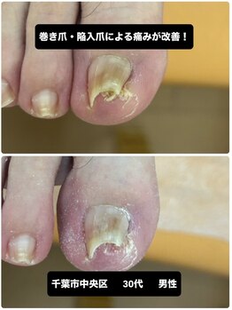 陥入爪の痛み専門施術でサポート