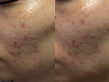 ルーク(Luke)/ニキビケア