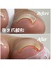 【巻き爪ケア&フットネイル】巻き爪緩和(両親指)&フットワンカラー¥11,000