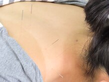 ビッグハンド/鍼灸