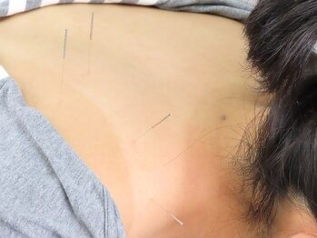 ビッグハンド/鍼灸