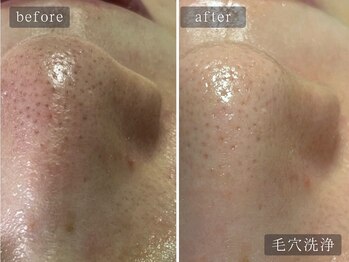 アムールサロン(Amour salon)/ハイドラ/毛穴洗浄/四谷三丁目