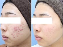 全国美肌コンテスト８年連続受賞！肌改善実績１万人以上