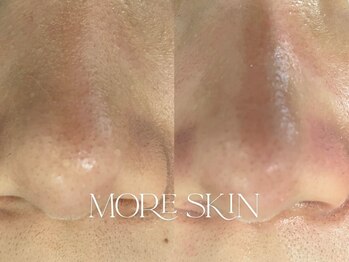 モアスキン 南青山店(MORE SKIN)/頑固な毛穴も、角栓どっさり