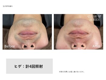 ティエル(TieLu)/ヒゲ脱毛