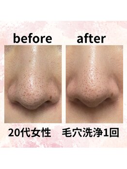 ラヴィアンローズ/大人気★毛穴洗浄