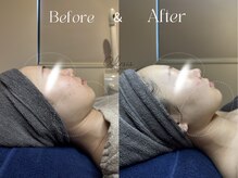 アイシス(AIsis)/【LDM+ハイドロ/20代】小顔/輪郭