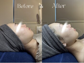 アイシス(AIsis)/【LDM+ハイドロ/20代】小顔/輪郭