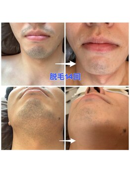 スパッツィオ(spazio)/【ヒゲ脱毛】14回 20代後半男性