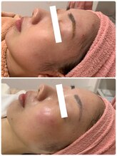 ジョアアンジェ 京橋店(joie ange)/赤みニキビケア