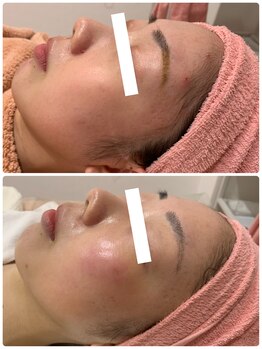 ジョアアンジェ 京橋店(joie ange)/赤みニキビケア