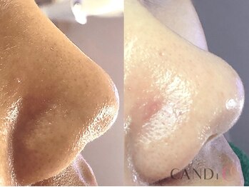 キャンディ 大阪梅田店(CANDi)/ハイドラピーリング/黒ずみ毛穴