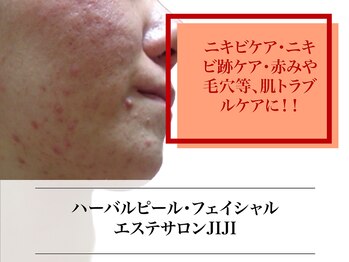 エステサロン ジジ 新宿(JIJI)/肌質改善で驚くほど変わる素肌