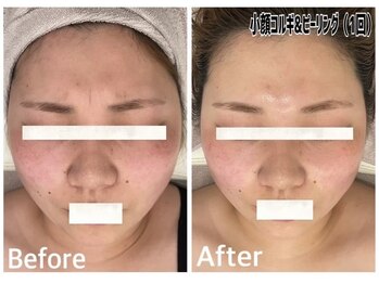 エイミー(Amy)/眉間のお悩み解消！ハリツヤUP！