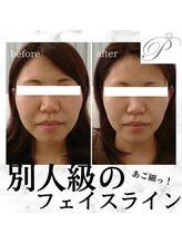 パールリフト 小田原店/フェイスライン/たるみ改善