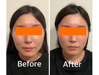 サロンベイビー 尼崎塚口店(Salon Baby)/【小顔美容整顔】Before・After