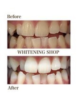 ホワイトニングショップ 新宿店/【ホワイトニング】BeforeAfter