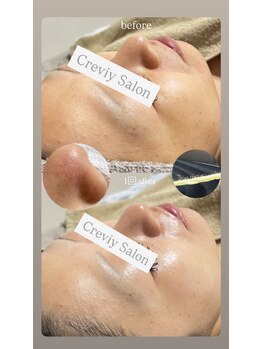 クレヴィー(Creviy)/韓国式3D毛穴洗浄+ハーブ+脱毛