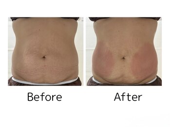 カノア(KANOA)/脂肪冷却