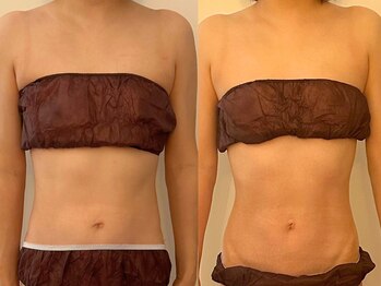 ヒールパーム(Heal Palm)/ウルトランスフォーマー3回★