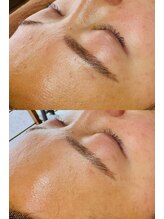 ルーク(Luke)/毛穴ケア