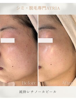 アトリア(ATRIA)/純粋レチノールピール