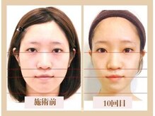 ビキュール 表参道店(美cuol)/10回目の小顔コルギ