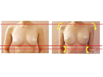 ココシア 取手店(COCOCIA)/バストアップ症例★