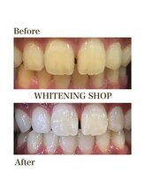 ホワイトニングショップ 新宿店/【ホワイトニング】BeforeAfter