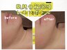 【韓国発!小顔人気No.1★お顔の脂肪撃退】プラズマシャワー×レモンボトル2cc