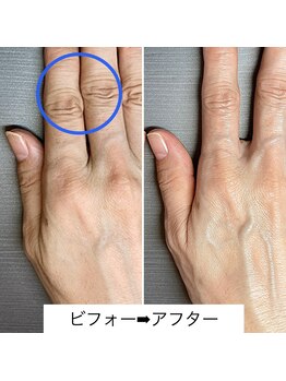 桃の木 吉祥寺店/ハンドスパでふっくら潤う手