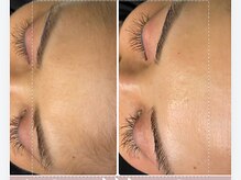 アリュール(Allure)/フェイシャルWax