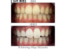 ホワイトニングショップ 静岡店/ホワイトニングBefore→After