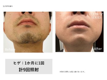 ティエル(TieLu)/ヒゲ脱毛