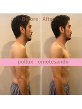 ポルクス鍼灸整骨院 表参道(Pollux鍼灸整骨院)/EMS ビフォーアフター