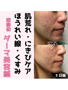 みき接骨院/姫路初ダーマ美容鍼＋ヒト幹細胞