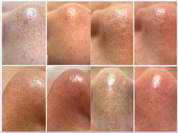 フェリス(FELIZ)/韓国式3D毛穴洗浄