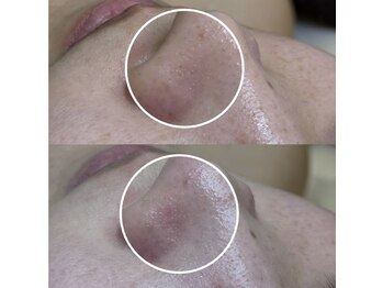 ビオルブ(VIOLVE)/ハーブピーリング&毛穴洗浄