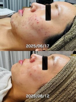 ルーク(Luke)/ニキビケア