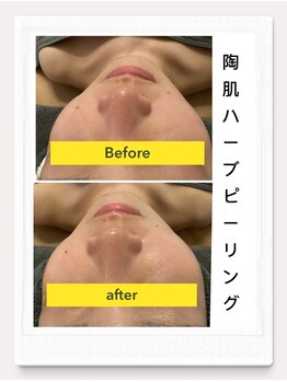 ルル リラクゼーション(RURU Relaxation)/陶肌ハーブピーリング